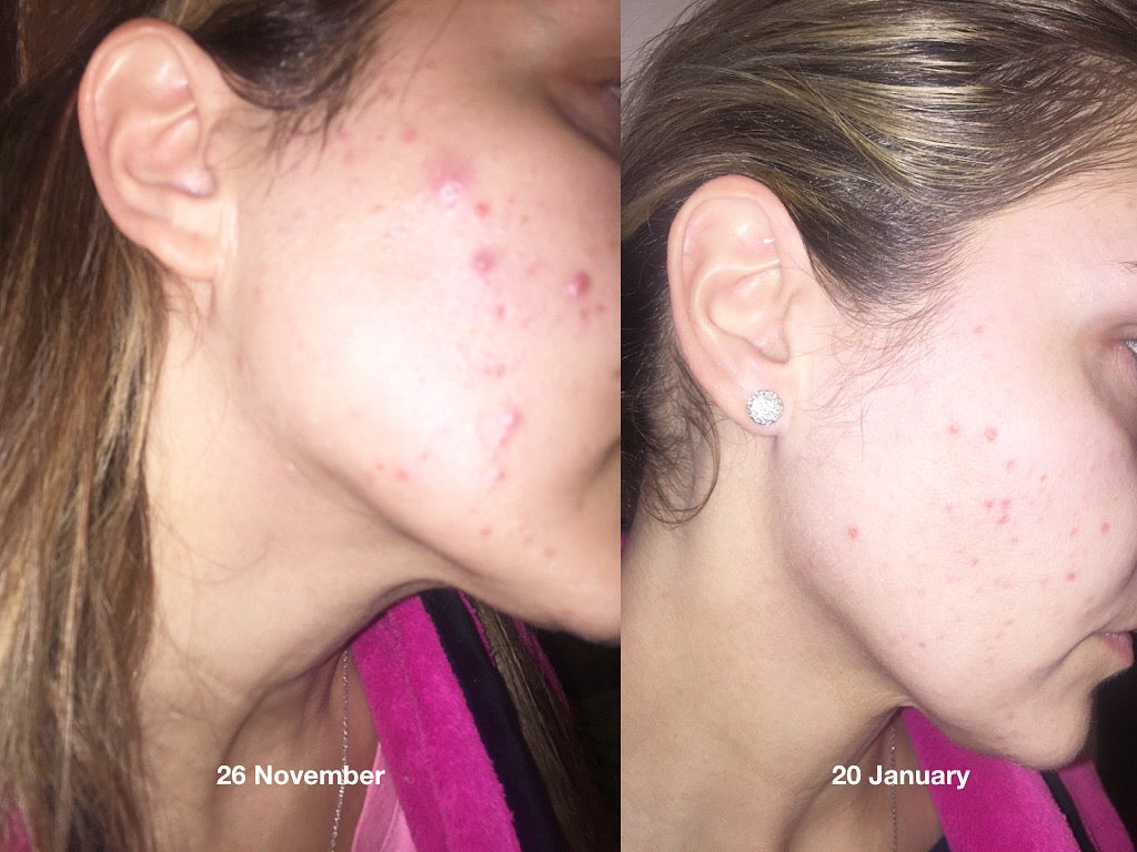 Blemish Skincare Routine
